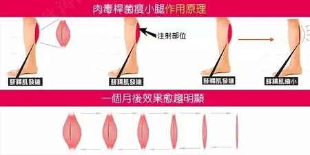 這有一個快速又持久瘦小腿的方法！請注意查收！