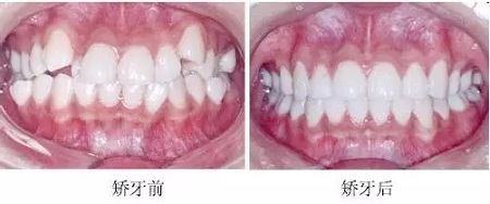 新品：整牙=換臉？隱適美IGO實(shí)現(xiàn)所有不可能！