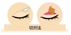 雙眼皮我想做埋線，為什么醫(yī)師建議我做全切雙眼皮