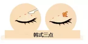 雙眼皮我想做埋線，為什么醫(yī)師建議我做全切雙眼皮