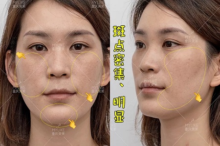 那個(gè)斑點(diǎn)女孩后來(lái)怎么樣了？