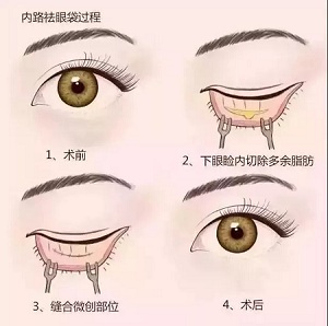 美萊實(shí)驗(yàn)室：分型祛除眼袋，拒絕+10歲