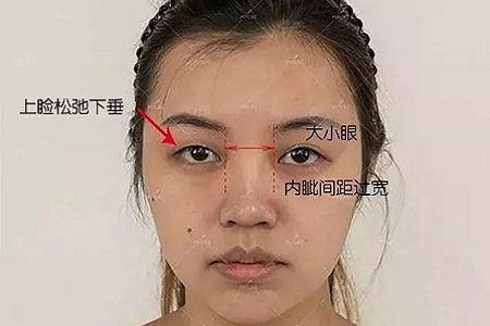 大小眼、不對稱，你是長胖了還是真老了？