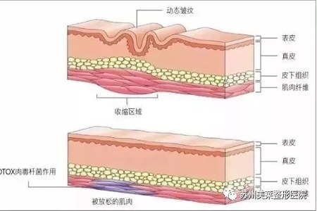 你無法用玻尿酸除掉所有皺紋！