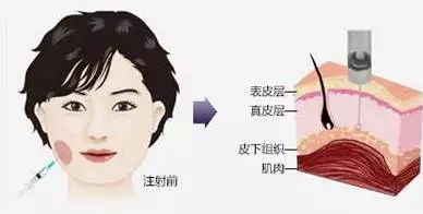 瘦臉會導(dǎo)致臉部凹陷松弛？