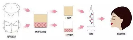 明星的臉和你的臉差的只是這一步！--面部脂肪填充
