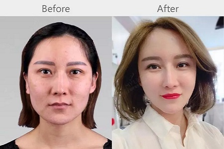 明星的臉和你的臉差的只是這一步！--面部脂肪填充