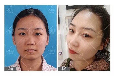 顏值：插座鼻變小翹鼻，就是這么神奇！