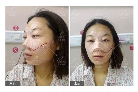 顏值：插座鼻變小翹鼻，就是這么神奇！