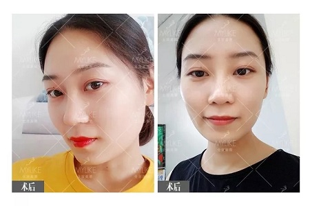 顏值：插座鼻變小翹鼻，就是這么神奇！