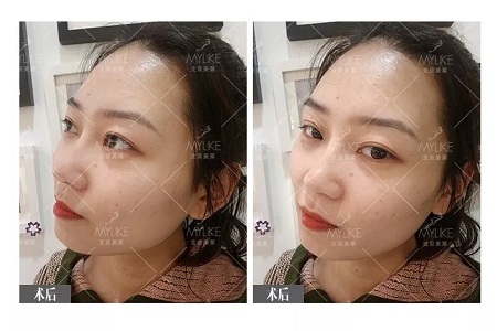 顏值：插座鼻變小翹鼻，就是這么神奇！