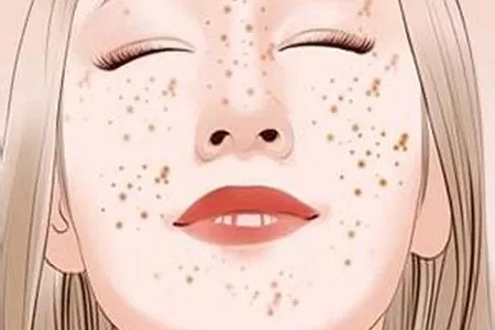 問診室：祛斑不難，找對病因才是重點，祛斑較全面科普看過來