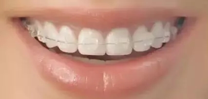 問(wèn)診室：關(guān)于正畸，不止你想的這么簡(jiǎn)單喔