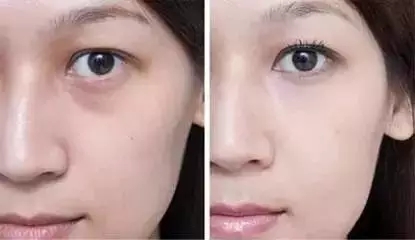 還把眼袋當(dāng)臥蠶？那就別怪小弟弟喊你阿姨了