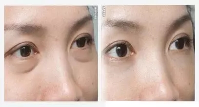 還把眼袋當(dāng)臥蠶？那就別怪小弟弟喊你阿姨了