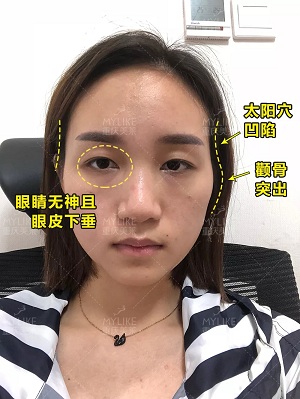 自體脂肪+雙眼皮，這對(duì)cp你不pick一下嗎？