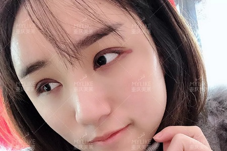 自體脂肪+雙眼皮，這對(duì)cp你不pick一下嗎？