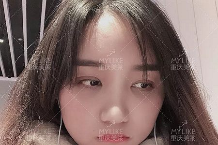 自體脂肪+雙眼皮，這對(duì)cp你不pick一下嗎？