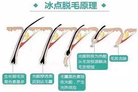 既便宜又安全的脫毛方法是什么？