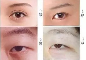 美萊實(shí)驗(yàn)室：開(kāi)眼角就是醫(yī)師想多收錢(qián)？
