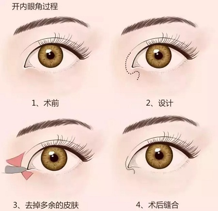 美萊實(shí)驗(yàn)室：開(kāi)眼角就是醫(yī)師想多收錢(qián)？