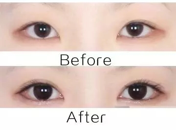 美萊實(shí)驗(yàn)室：開(kāi)眼角就是醫(yī)師想多收錢(qián)？