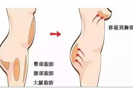 問(wèn)診室：你說(shuō)脂肪壓得你好累，殊不知它也可以是寶貝