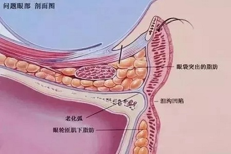 顯老淚溝，你還要任其放肆嗎？
