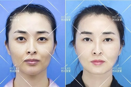 顯老淚溝，你還要任其放肆嗎？