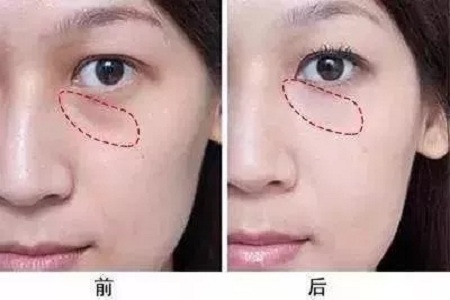 顯老淚溝，你還要任其放肆嗎？
