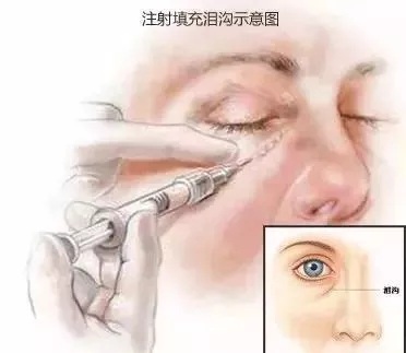 顯老淚溝，你還要任其放肆嗎？