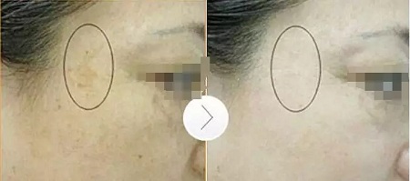 超皮秒激光祛斑，實(shí)力素顏，不加“斑”