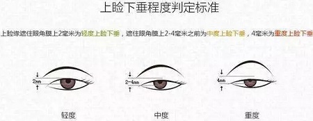 據(jù)說80%的亞洲女性都有這一眼部通病，上瞼下垂你了解過嗎？