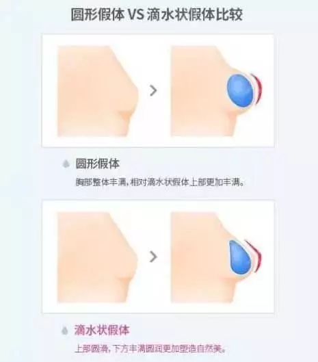 [我問大醫(yī)師]隆乳手術(shù)問題，你想要的答案，這里都有