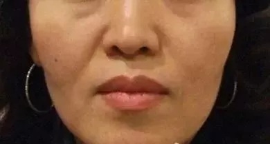 用玻尿酸治療鼻唇溝，一定要注意這種情況！