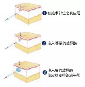 用玻尿酸治療鼻唇溝，一定要注意這種情況！