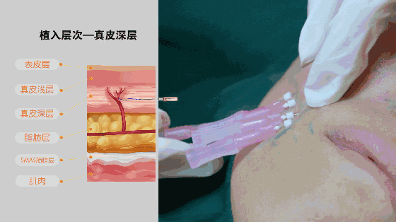 用玻尿酸治療鼻唇溝，一定要注意這種情況！