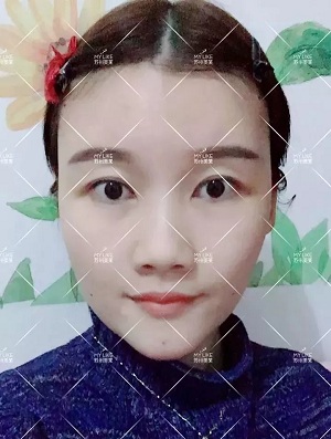 面部填充會不會把臉填大？