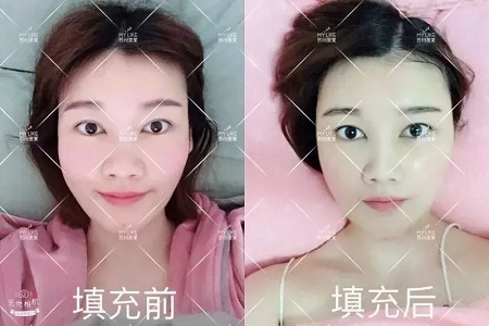 面部填充會不會把臉填大？