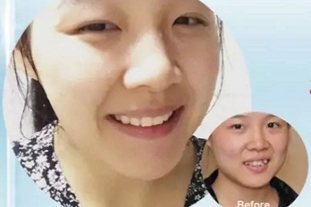 有效數(shù)據(jù)生成，預(yù)見牙齒矯正后的自己