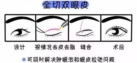 美眼張誠坐診美萊，淺談為什么你的眼睛不夠美？