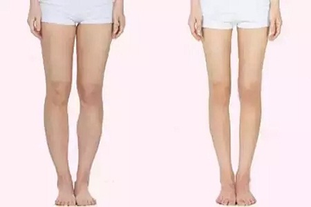 問診室 | 大腿吸脂后多久可以運(yùn)動(dòng)？