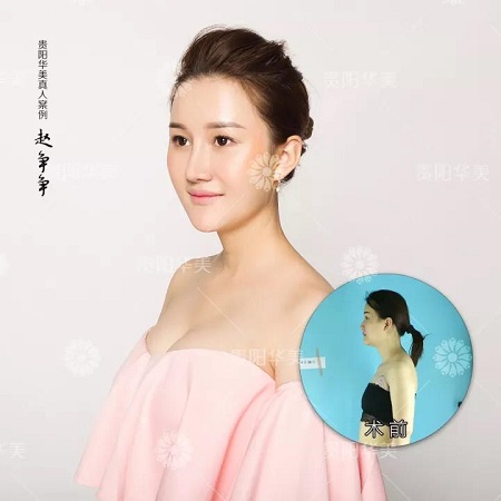 假體隆胸，解決平胸?zé)?></a>
                                    <a href=