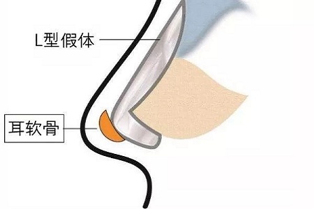 想知道身邊人有沒有做過隆鼻？看完這篇文章你就知道了