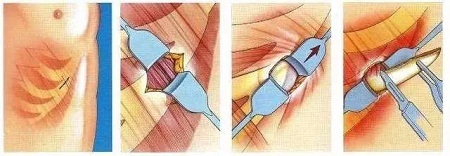 想知道身邊人有沒有做過隆鼻？看完這篇文章你就知道了
