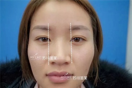 鼻子不是越高越好看！