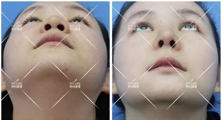 鼻子不是越高越好看！