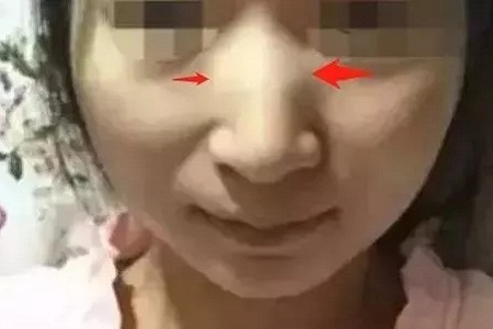 側(cè)面看鼻梁不矮,正面看鼻子卻很塌是什么原因？