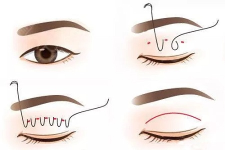 ?雙眼皮手術(shù)只聽過全切？還有哪些眼部手術(shù)方法？
