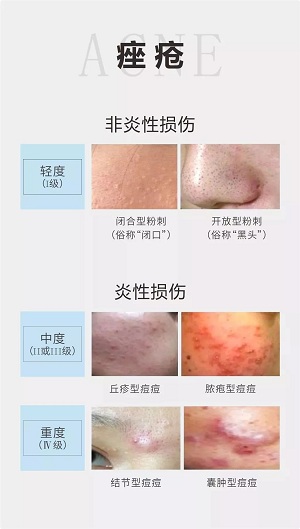 痤瘡分為粉刺和毛囊炎兩大類，按輕重程度分成四個(gè)等級(jí)